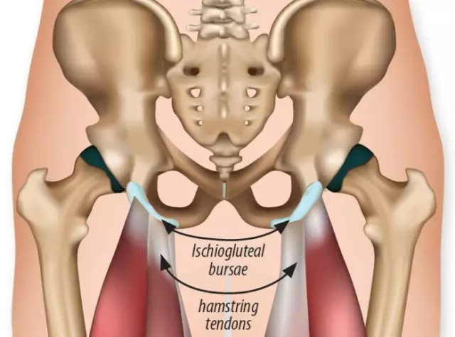 Pain In The Buttocks Worries, What To Do