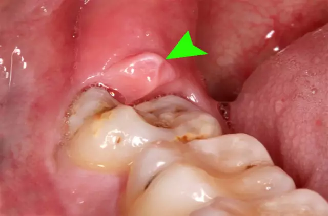 Wisdom Tooth Hurts - Treat Or Remove