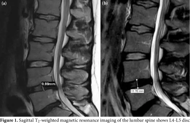 The Concept Of "Resorption Of Intervertebral Disc Herniation" Returns To Clinical Practice