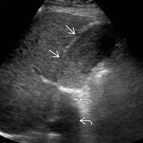 Treatment Of Bile Stasis