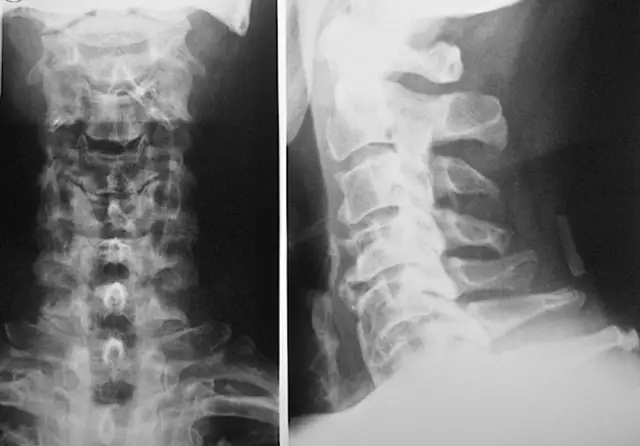 Treatment Of Cervicothoracic Osteochondrosis - Effective And Without Doctors