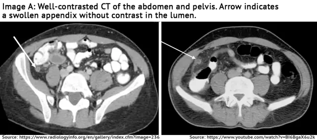 How To Cope With Pyelonephritis Without Negative Consequences For The Body