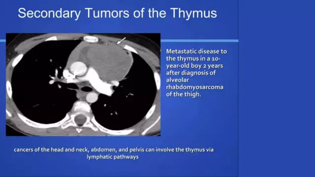 Mediastinum - Structure, Classification Of Tumors, Nodes, Symptoms