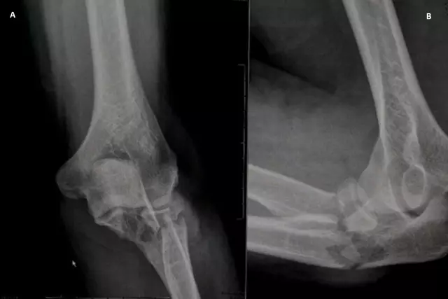 Ulna - Structure, Fracture, After Fracture