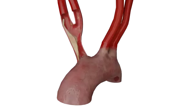 Aortic Arch - Branches, Structure, Diseases