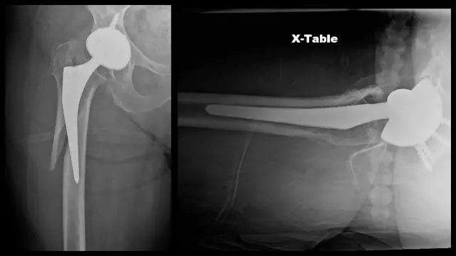 Femur - Structure, Fracture And Its Signs, Necrosis, Treatment