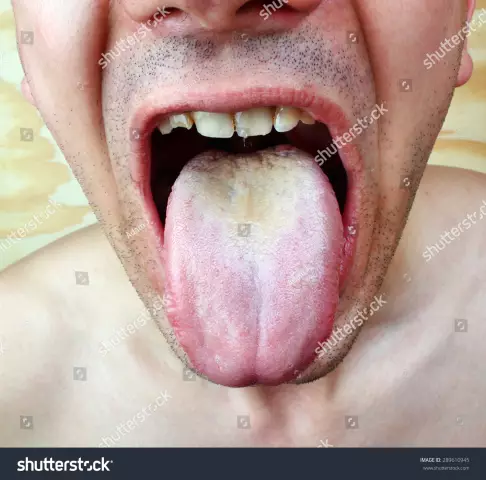 Tongue - Pain, White Coating And Yellow Coating