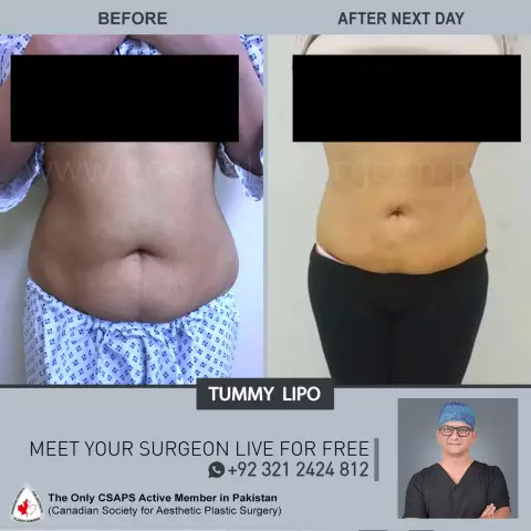 Liposuction - Reviews, Before And After