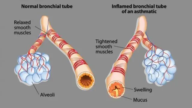 Asthme Bronchique - Dictionnaire Des Termes Médicaux