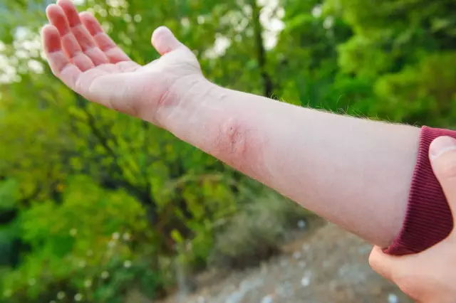 First Aid For A Wasp Sting - How To Help, What To Do, Folk Remedies