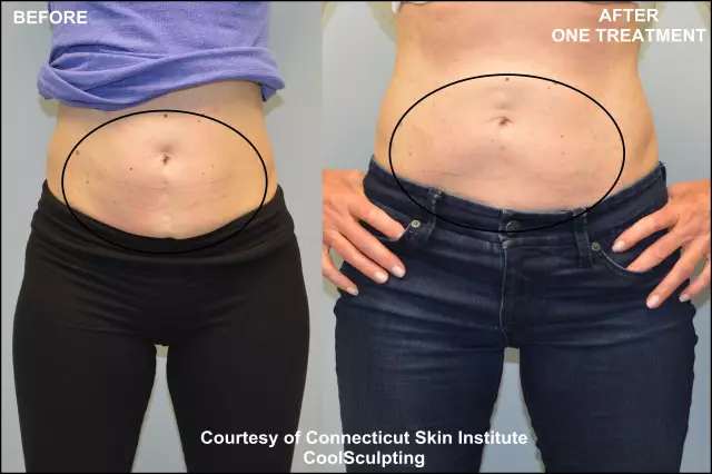 Abdominoplasty Of The Abdomen - Reviews, Before And After