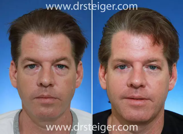 Blepharoplasty - Indications, Contraindications, Reviews, Before And After