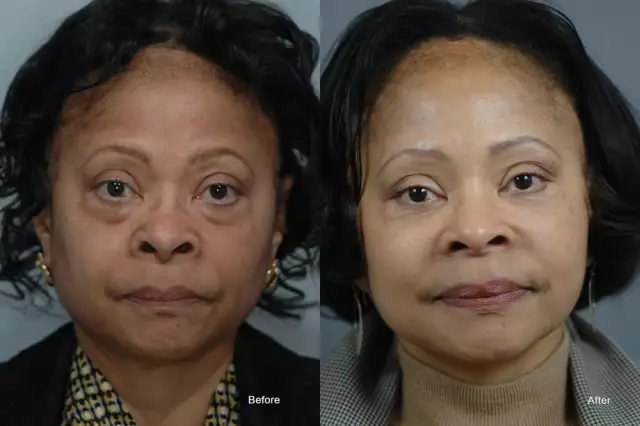 Facial Contouring - Methods, Contraindications, Complications, Reviews