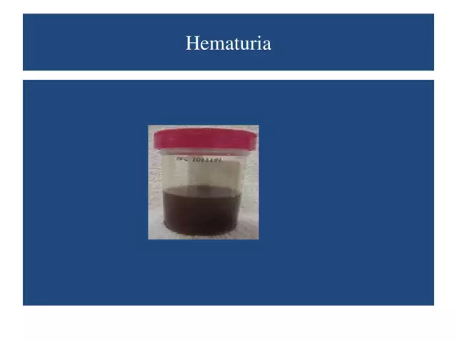 Hematuria - Glossary Of Medical Terms