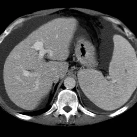 Hyperplasia - Glossary Of Medical Terms