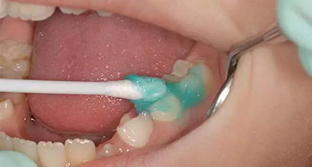 Fluoride Varnish - Instructions For Use, Coating, Reviews