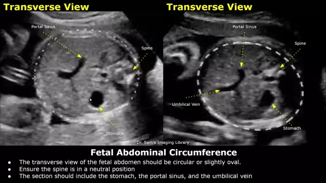 25 Weeks Pregnant - Fetal Changes, Abdomen, Pains, Examinations