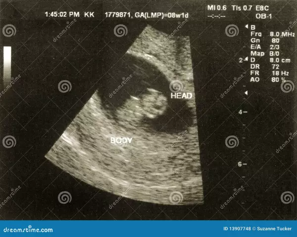 33 Week Of Pregnancy - Changes In The Fetus, Examinations, Ultrasound